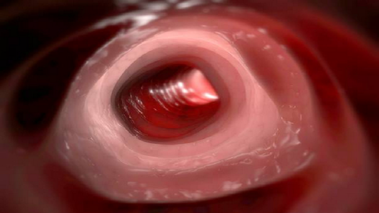 رجل يصاب بالشلل بسبب تراكم البراز في أمعائه!