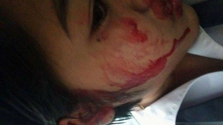 فيتنامية تعاني من حالة نادرة تجعلها تتعرق دما!