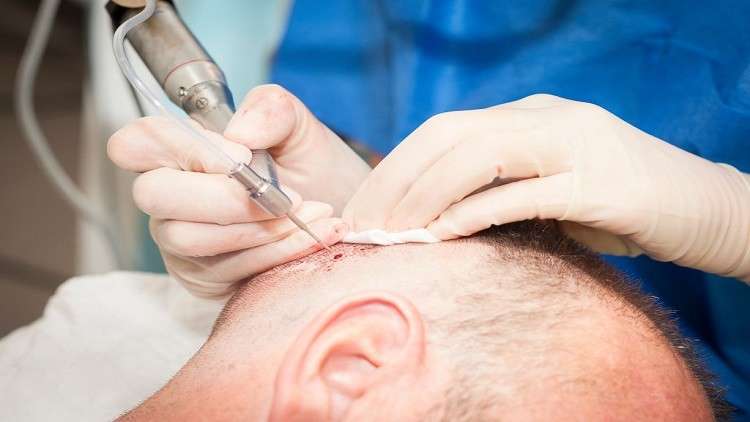وفاة رجل أعمال بعد عملية زراعة شعر دامت 12 ساعة!