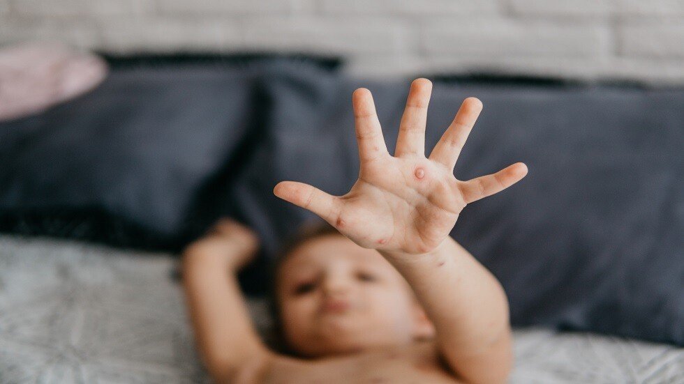 الحصبة تمحو "ذاكرة" جهاز المناعة وتمنعه من محاربة الأمراض