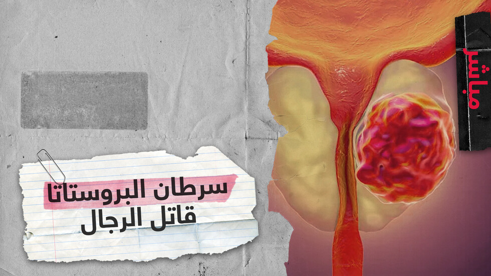 سرطان البروستاتا.. قاتل الرجال