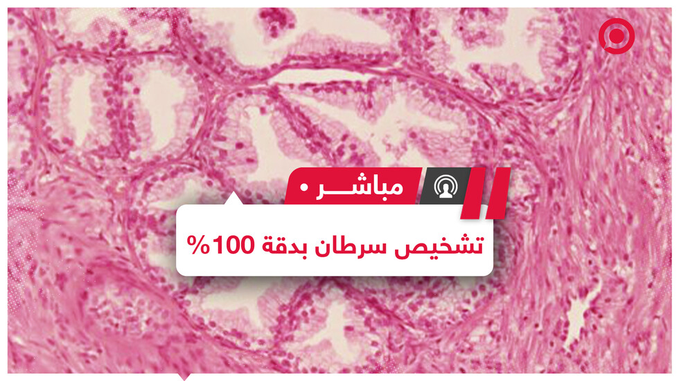 علماء المعهد الكوري للعلوم والتكنولوجيا يطورون تقنية لتشخيص "قاتل الرجال الصامت" في 20 دقيقة