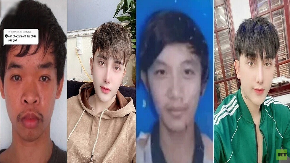دفع أكثر من 17 ألف دولار.. شاب يجري 9 عمليات تجميل بعد السخرية من شكله خلال مقابلة عمل! (فيديو+ صور)