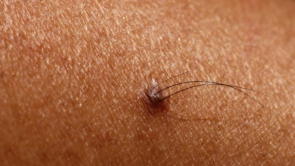 اختراق كبير في محاربة الصلع.. اكتشاف علاج محتمل لتساقط الشعر يكمن في الشامات المشعرة!