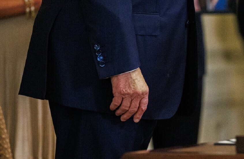 ترامب يغطي مجددا كدمة زرقاء على يده باستخدام كريم تجميل