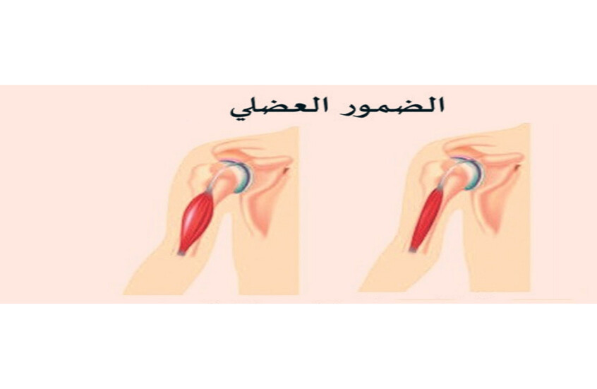 علماء روس يعملون على ابتكار أول دواء في العالم لعلاج ضمور العضلات