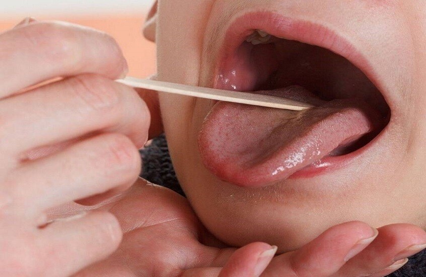 دراسة تربط استئصال اللوزتين لدى الأطفال بخطر الإصابة بالتصلب المتعدد