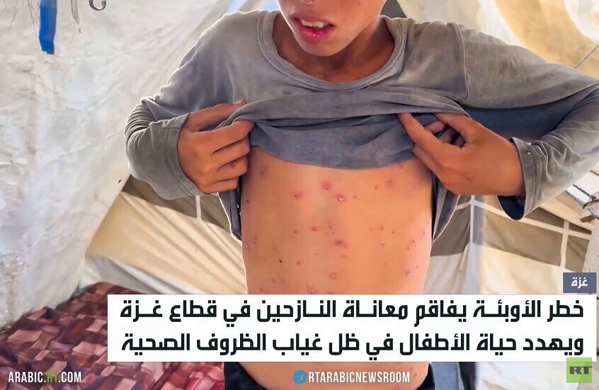غزة.. معاناة بين القصف والأوبئة