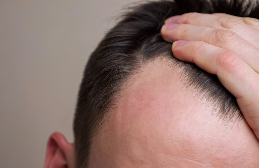 أدوية إنقاص الوزن قد ترتبط بتساقط الشعر لدى الرجال