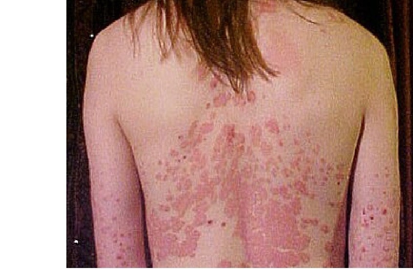 العامل الرئيسي وراء الإصابة بمرض الصدفية